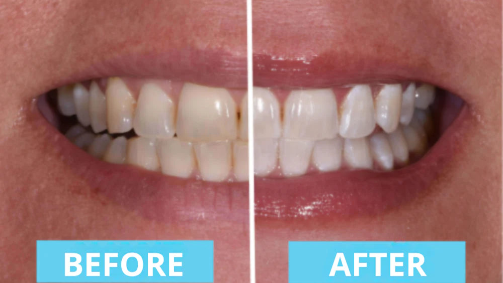 Final 3 Hours: 66% OFF🔥 Nova™ Premium Teeth Brush