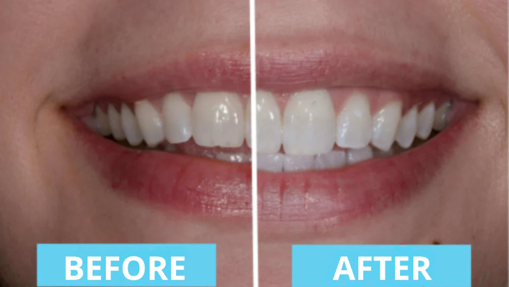 Final 3 Hours: 66% OFF🔥 Nova™ Premium Teeth Brush