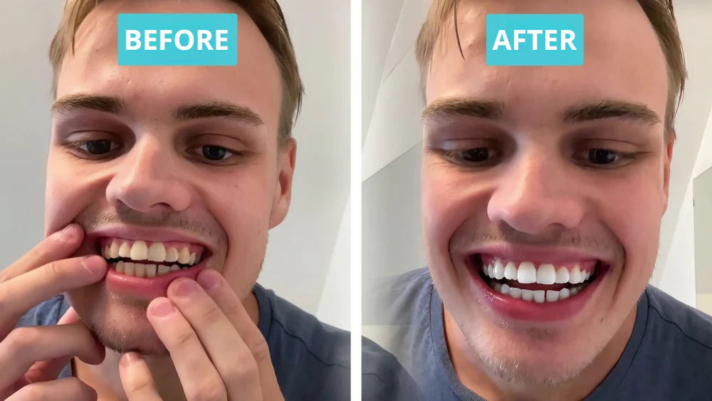 Final 3 Hours: 66% OFF🔥 Nova™ Premium Teeth Brush